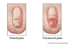 Circumcision In Older Boys What To Expect At Home