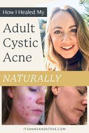 cystic acne naturally