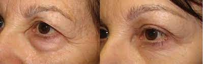 hollow upper eyelids the best way to