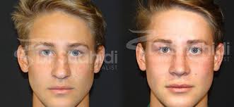 Maybe you would like to learn more about one of these? Male Rhinoplasty Before And After Gallery