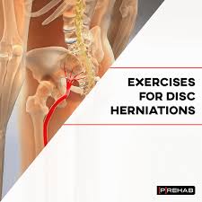 exercises for disc herniations p rehab