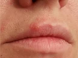 laser cold sore and canker sore