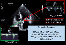 Aortic Stenosis Severity