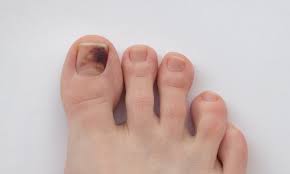 The signs of toenail fungus are actually thick toenails or black toenails may not be your typical toenail fungus symptoms, but could at. What S Causing The Black Spot Beneath My Nail My Footdr