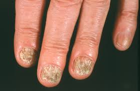 nail fungus foothill dermatology