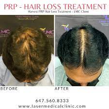 1 powerful prp hair treatment toronto