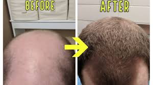 How often should you do microneedling for fine lines? Crazy Microneedling Results To Stop Balding And Hair Loss Youtube