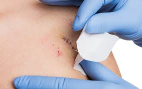 wound care after surgery at bergen
