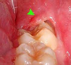 pericoronitis types causes signs