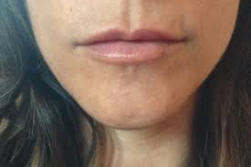 dent above upper lip after juvederm