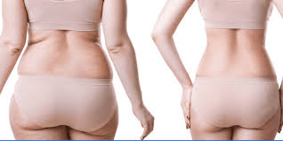gain weight after a gastric sleeve