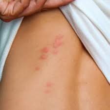 Although they are caused by different insects, they both manifest themselves on the skin in the same compare the pictures with your symptoms. Bed Bug Bite Identification Schendel Blog