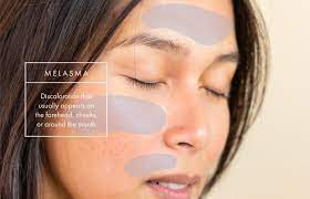 melasma what causes it and how you can