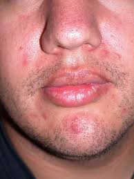 treating acne in males
