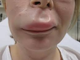 traumatic angioedema litfl