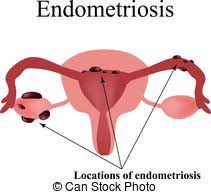 Endometriosis is typically seen during the reproductive years; Endometriosis Meaning In Hindi Live Fit India