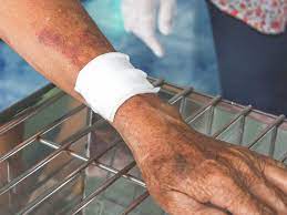 blood clot in arm symptoms treatment