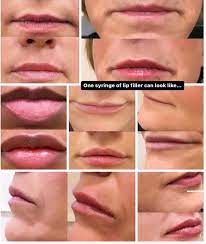 lip filler cameo skin and body wellness