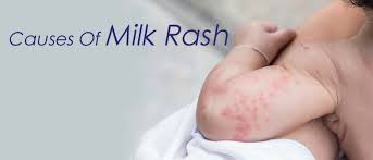 causes of milk rash cussons baby nigeria