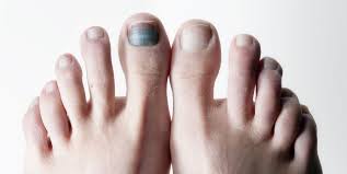 The prolonged discoloration and darkening of nails. Black Toenail Subungual Hematoma And Bruised Toenails For Runners