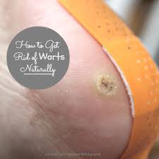 how to get rid of warts naturally with