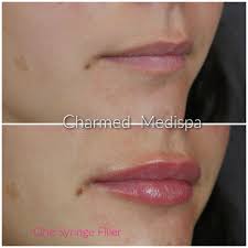 lip filler with less swelling charmed