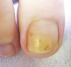 footlogix toenail fungus treatment