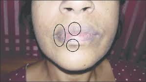 darkening of the involved areas of lips