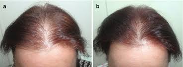 nutritional correction for hair loss