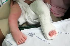 The main treatment, called the ponseti method, involves gently manipulating and stretching your baby's foot into a better position. Clubfoot Treatment Services In Veerbhadra Nagar Pune Id 19136445088