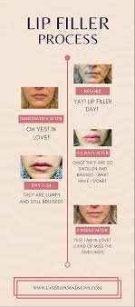 lip fillers are best for you laser lipo