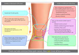knee pain location chart diagnose your