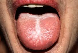 Pictures What Your Tongue Says About Your Health