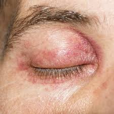 how to treat eczema on eyelids in