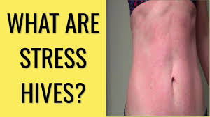 They are called anxiety symptoms because anxiety is the main source of the stress that causes the body to. Stress Hives What Are Stress Hives How To Cure Hives From Stress Fast Cure Stress Hives Youtube