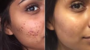 controversial cystic acne routine goes
