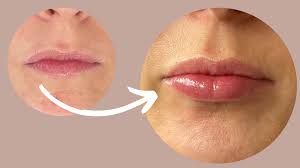 lip fillers for thin lips