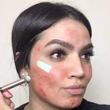 makeup tutorial for covering up acne