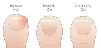 avoid ingrown toenails by knowing how