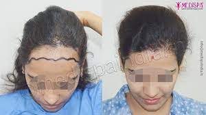 female hair transplant women hair