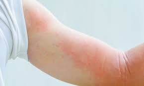 toxic mold rash