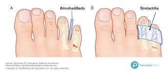 fisura del dedo pequeño del pie