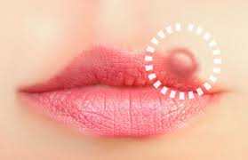 cold sores with natural remes