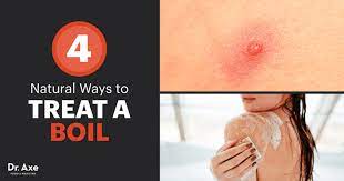 a boil how to prevent boils