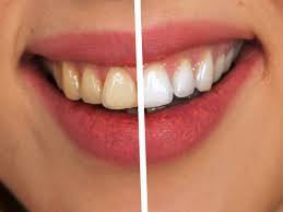 how can i whiten my teeth quickly