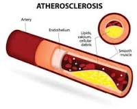 How Vitamin K2 Reduces Atherosclerosis - Life Extension