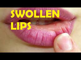 swollen lips after kissing