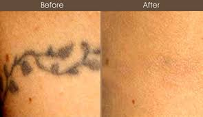 tattoo removal nyc birthmark removal