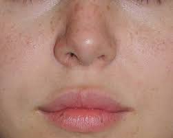 lip augmentations with fat injections