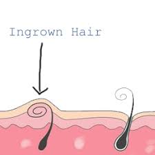 an ingrown hair on your line